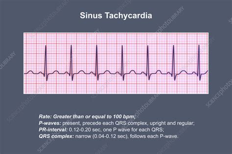 why does sinus tachycardia typically develop pals