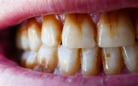 Why Does Smoking Cause Yellow Teeth