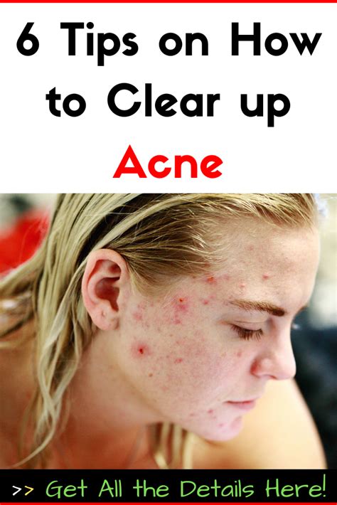 Why Does Tanning Clear Up Acne