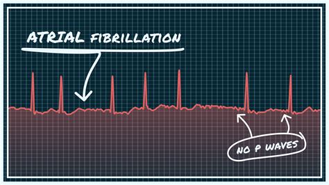 Why Doesn't A Pacemaker Control Afib