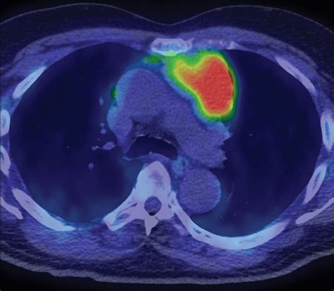 Why Is Choline Bad For Prostate