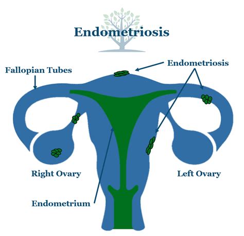 why is endometriosis so common