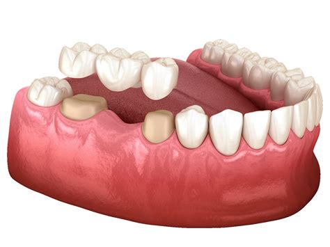 Why Is My Bridge Bleeding