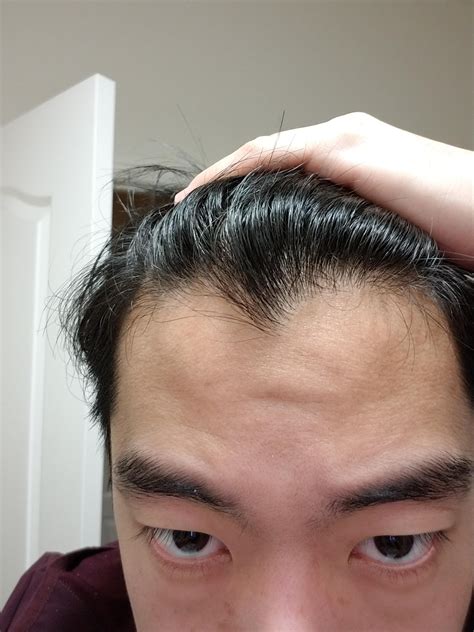 Why Is My Hairline Receding At 20 Male 