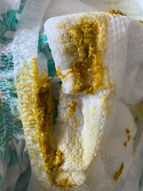 Why Is Newborn Poop Stringy