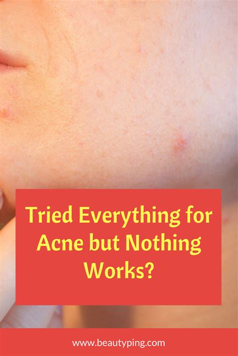 How I Healed My Acne By "Doing Nothing" YouTube