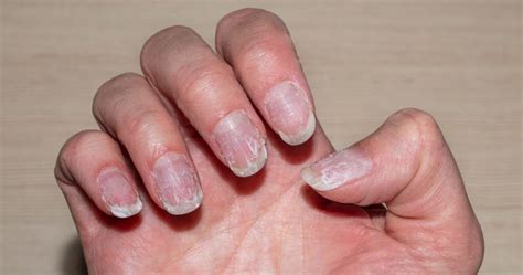 Why My Nails Are So Thin