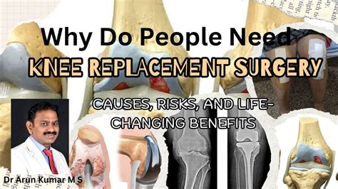 Why Need Knee Replacement