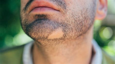 Why Patches In Beard