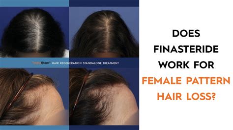 why should women not use finasteride