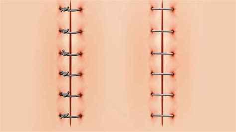 Why Use Staples Instead Of Sutures