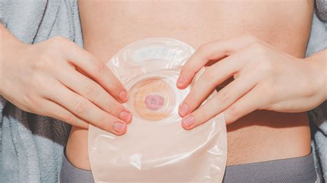 Why Use Stoma Bag