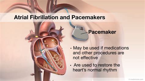 Why Would Someone With Afib Need A Pacemaker