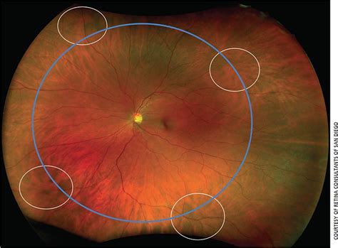 wide field retinal imaging