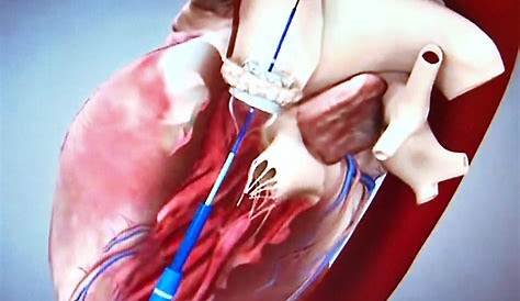 Wie wird eine Herzklappe ersetzt? - YouTube