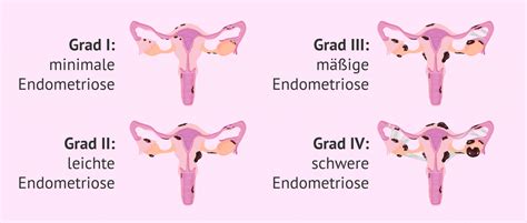 wie kann man endometriose diagnostizieren