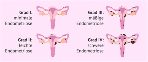 wie viele frauen leiden an endometriose