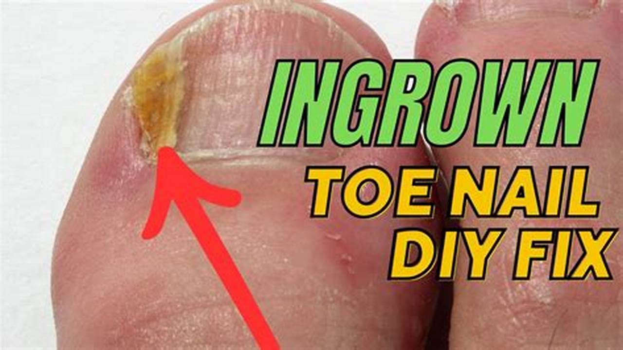 Will Ingrown Toenail Fix Itself?