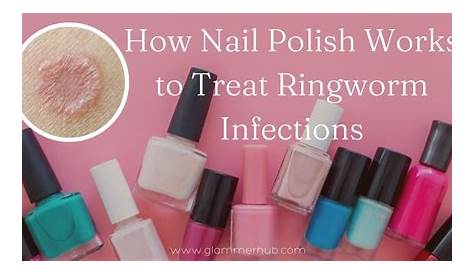 Will Nail Polish Kill Ringworm