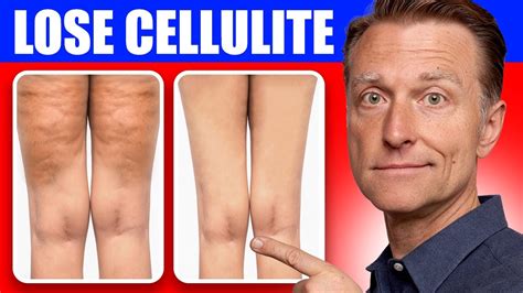 How to Lose Weight and Get Rid of Cellulite With a Mixture Made Up of
