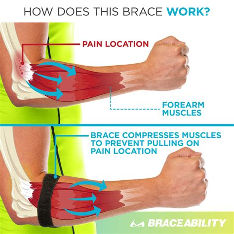 Will A Brace Help Elbow Tendonitis