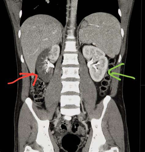 will a ct scan show colon cancer