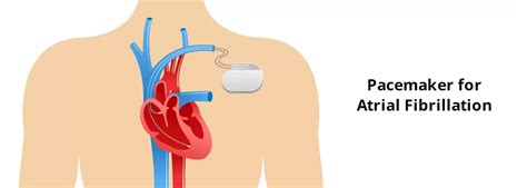 Will A Pacemaker Help Atrial Fibrillation
