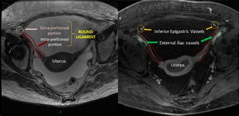 will a pelvic mri show endometriosis