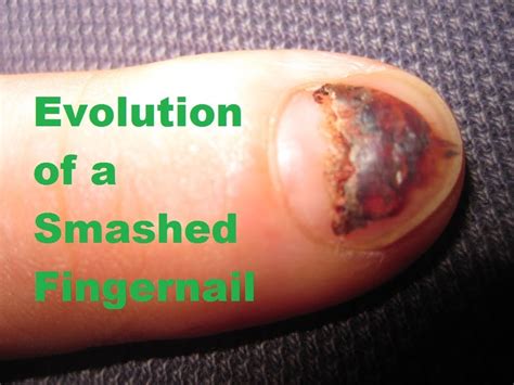 Will A Smashed Fingernail Grow Back