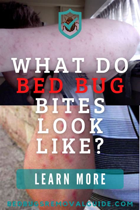 Will Bed Bugs Bite Your Face