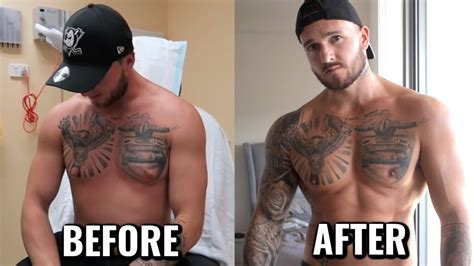 Will Gyno Return After Surgery