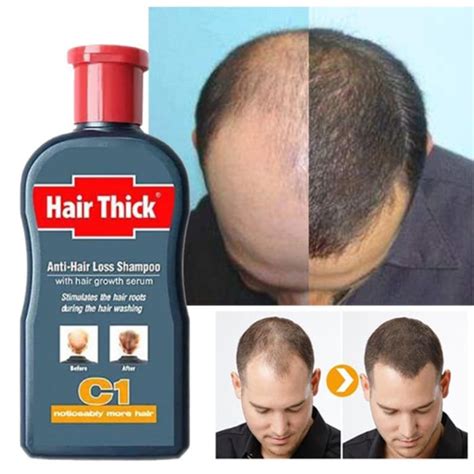  79 Popular Will Hair Loss From Shampoo Grow Back Hairstyles Inspiration