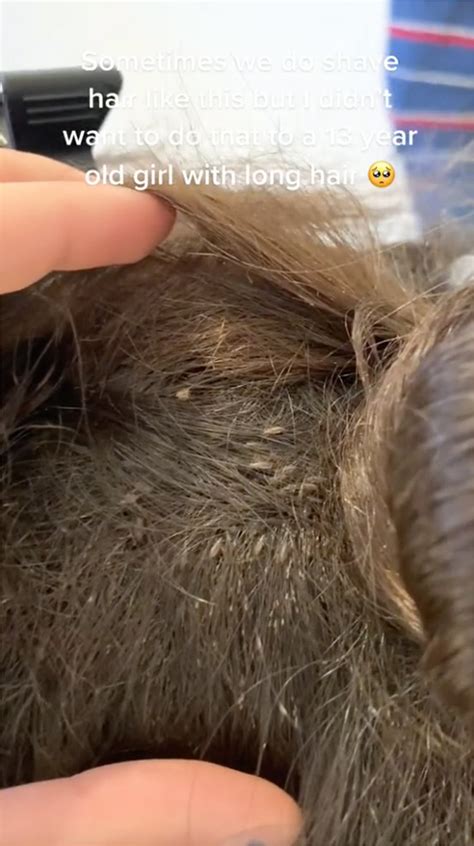 will peroxide kill head lice