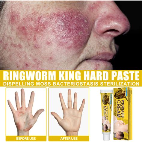 Will Steroid Cream Kill Ringworm