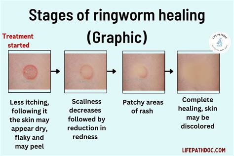 Will Steroids Help Ringworm