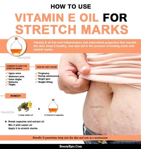 Will Vitamin E Help With Stretch Marks