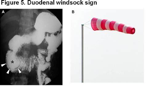 Windsock Deformity