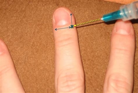 Wing Block Procedure