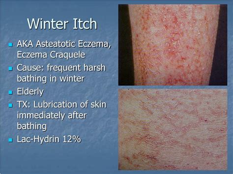 Winter Itch: Surprising Solutions to Relief