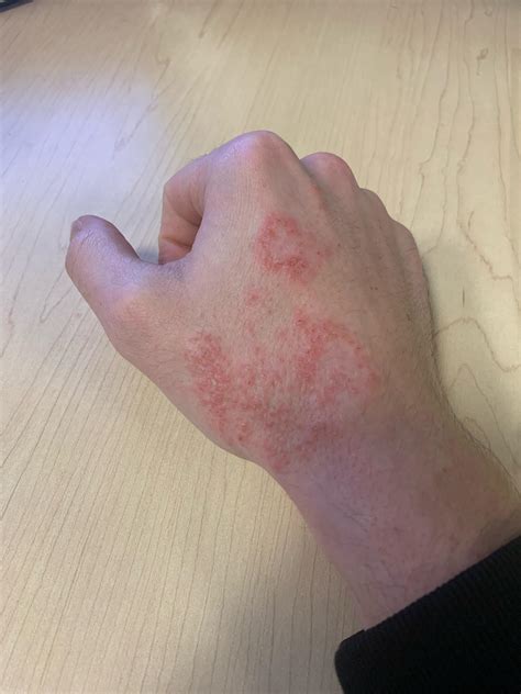 winter rash pictures on hands