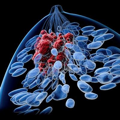 Wire Insert Before Breast Surgery