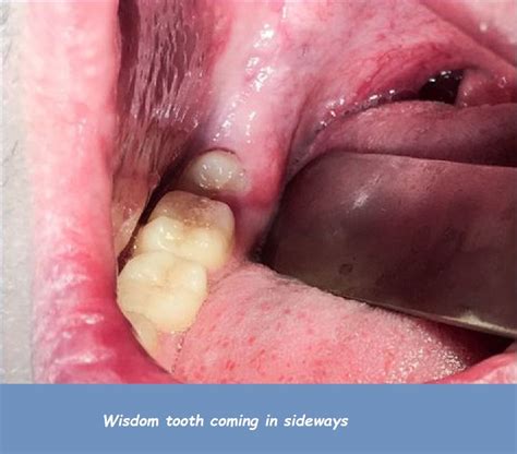wisdom teeth gums