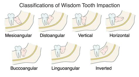 wisdom teeth impaction