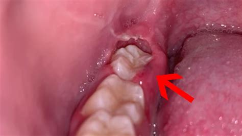 wisdom teeth pushing through gums