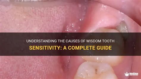 wisdom teeth sensitive