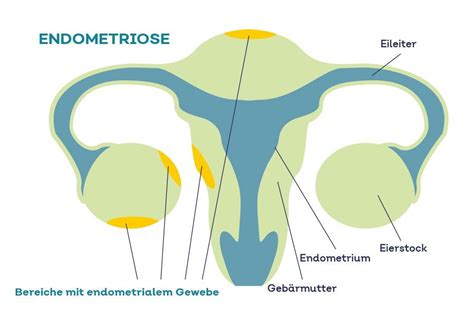 wo kann endometriose auftreten