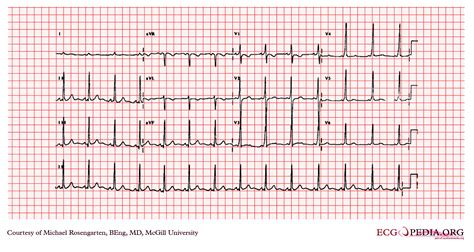 wolff parkinson syndrome ecg