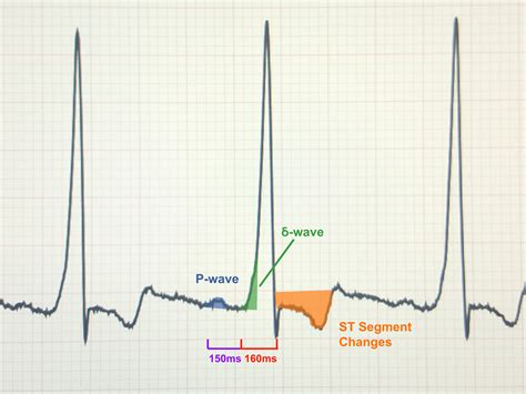 wolff parkinson white pattern on ekg