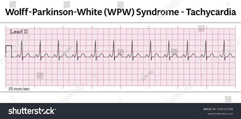 wolff parkinson white syndrome ecg vs normal