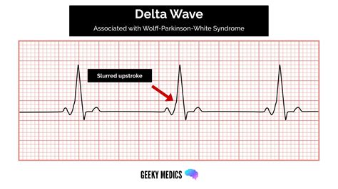 wolff parkinson white syndrome ekg delta wave